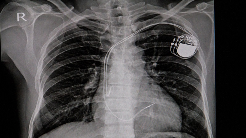 Die Geschichten rund um Fehlerhafte Medizinprodukte sind keine neuen Berichte, um die Zeitungen zu füllen. Tatsächlich beschäftigen sich Versicherungen, Ärzte und Patienten sowie Gerichte seit Jahren mit diesem Thema.(#01)